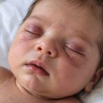 Nekoliko dana nakon rođenja naše bebe, na njezinu licu pojavila se neobična mrlja… 